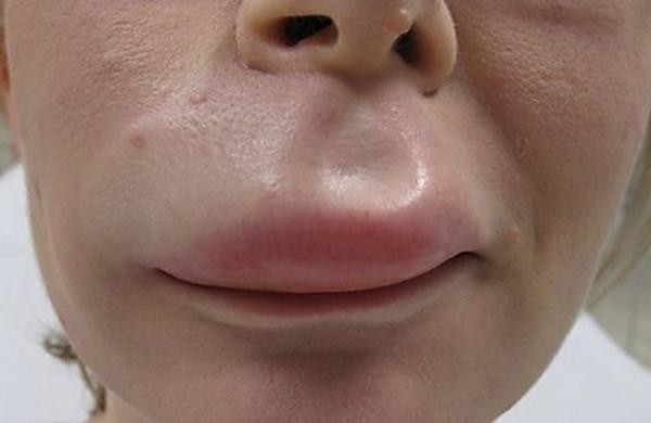 Очень опасна аллергия когда распухают губы, она может привести к удушью