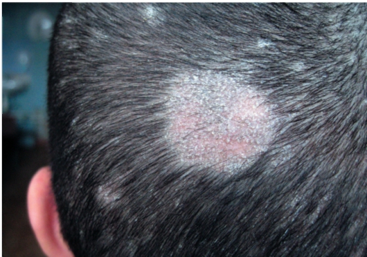 Страшные последствия грибка кожи головы